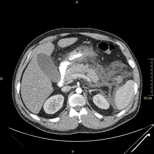 File:Acute pancreatitis (Radiopaedia 23231-23290 Axial C+ arterial phase 40).JPG