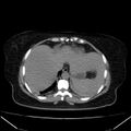 Acute pancreatitis - Balthazar C (Radiopaedia 26569-26714 Axial non-contrast 17).jpg