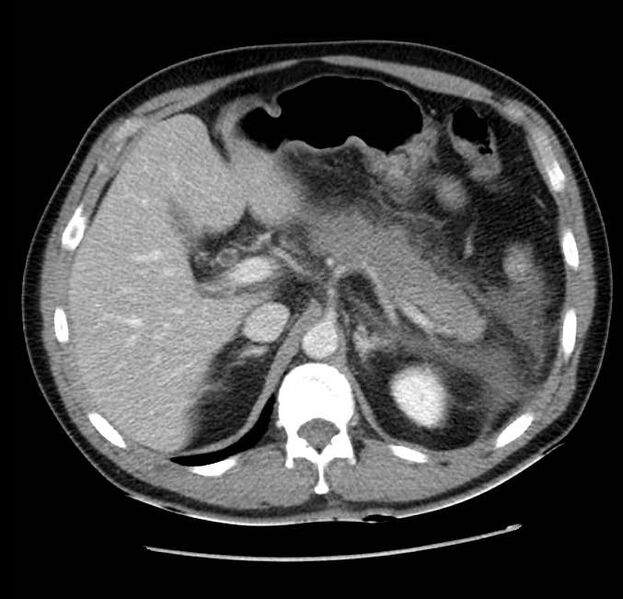 File:Acute pancreatitis - Balthazar E (Radiopaedia 23080-23110 Axial C+ portal venous phase 19).jpg