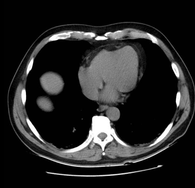 File:Acute pancreatitis - Balthazar E (Radiopaedia 23080-23110 Axial non-contrast 3).jpg