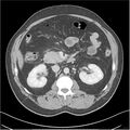 Acute pancreatitis - mild (Radiopaedia 27796-28033 C+ portal venous phase 19).jpg