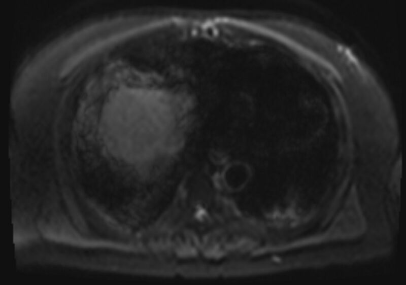 File:Acute portal vein thrombosis (Radiopaedia 73198-83925 Axial DWI 6).jpg