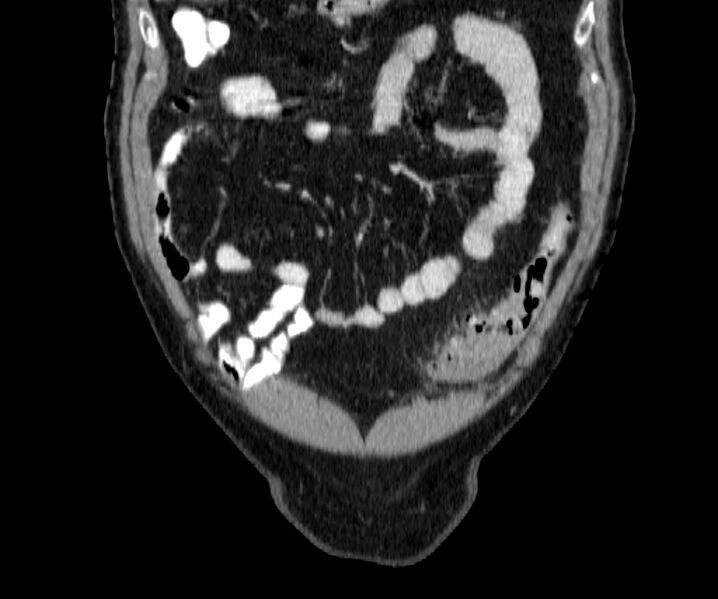 File:Acute sigmoid colon diverticulitis (Radiopaedia 55507-61976 Coronal C+ portal venous phase 16).jpg