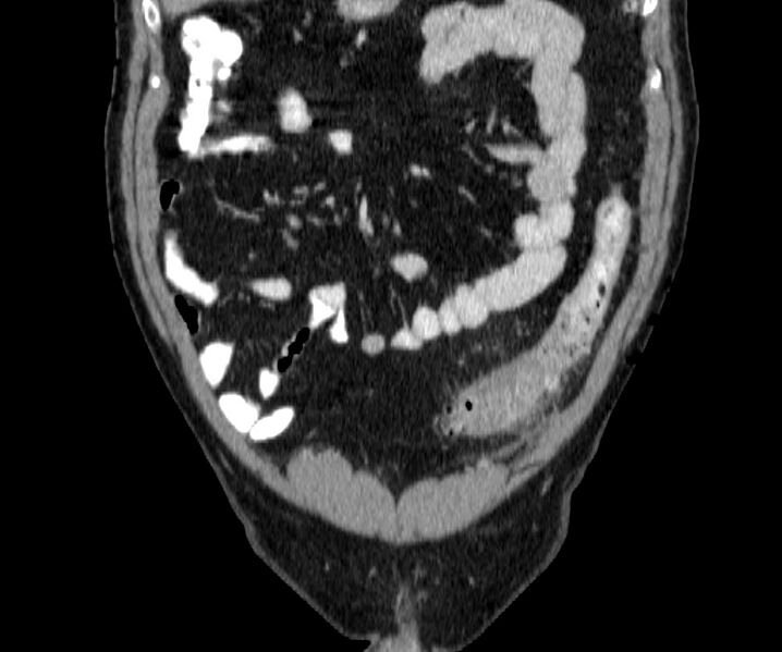 File:Acute sigmoid colon diverticulitis (Radiopaedia 55507-61976 Coronal C+ portal venous phase 28).jpg