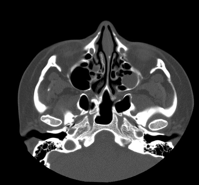 File:Acute sinusitis (Radiopaedia 22419-22455 Axial non-contrast 15).jpg