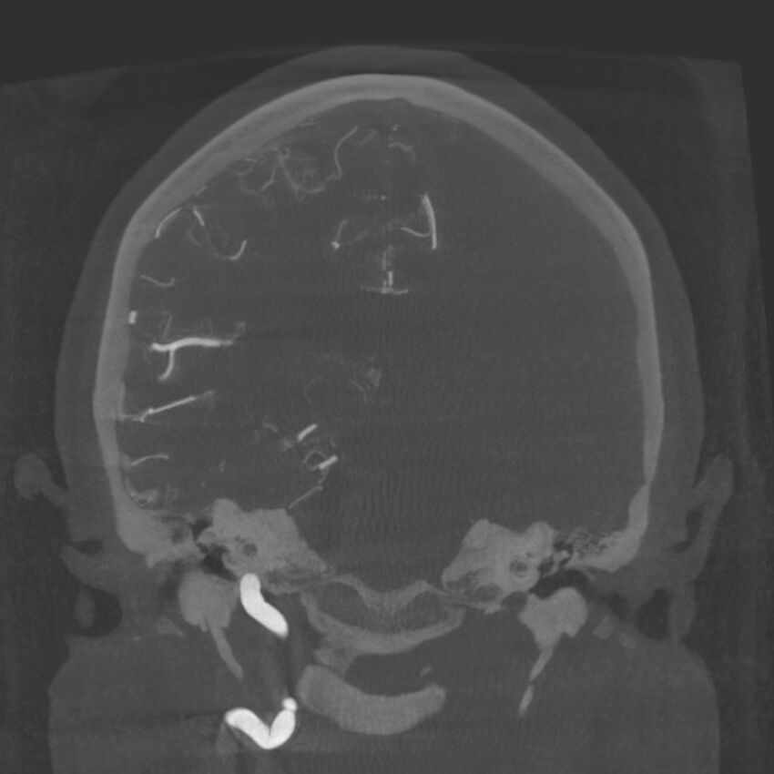 Acute subarachnoid hemorrhage and accessory anterior cerebral artery (Radiopaedia 69231-79010 Coronal arterial - MIP 61).jpg