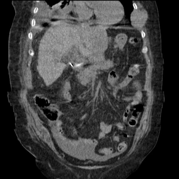 File:Acute tubular necrosis (Radiopaedia 28077-28334 D 34).jpg