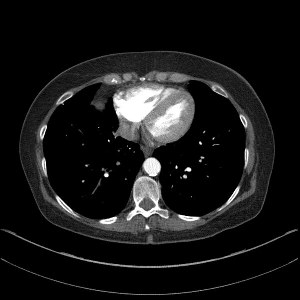 File:Adenocarcinoma of the lung (Radiopaedia 44205-47803 Axial C+ portal venous phase 61).jpg