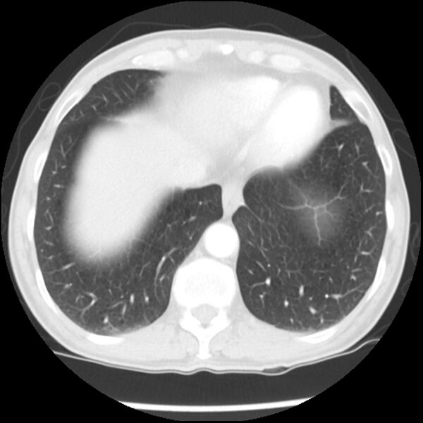 File:Adenocarcinoma of the lung - micropapillary predominant (Radiopaedia 42446-45563 Axial lung window 60).jpg