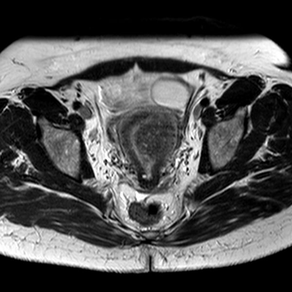 File:Adenomyoma of the uterus (Radiopaedia 9871-10439 Axial T2 15).jpg
