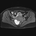 Adenomyosis and endometriotic cysts (Radiopaedia 82300-96367 Axial T1 C+ fat sat 16).jpg