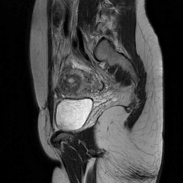 File:Adenomyosis within a septate uterus (Radiopaedia 69963-79981 Sagittal T2 10).jpg