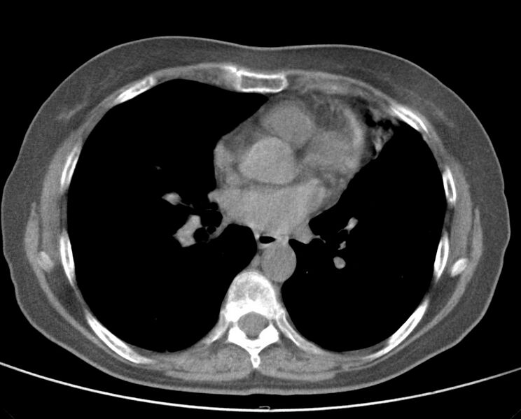 File:Adenosquamous lung carcinoma (Radiopaedia 22035-22030 non-contrast 35).jpg
