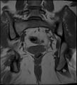 Adnexal multilocular cyst (O-RADS US 3- O-RADS MRI 3) (Radiopaedia 87426-103754 Coronal 23).jpg