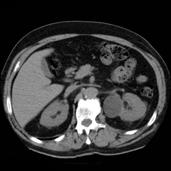 File:Adrenal hemangioma (Radiopaedia 11039-11445 Axial non-contrast 10).jpg