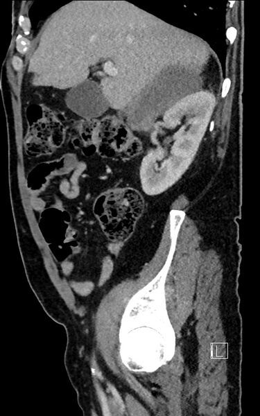 File:Adrenal lymphoma (Radiopaedia 73730-84529 Sagittal C+ portal venous phase 33).jpg