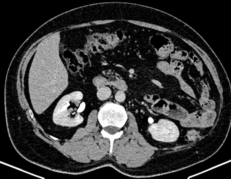 File:Adrenal metastases (Radiopaedia 73082-83791 Axial C+ delayed 154).jpg