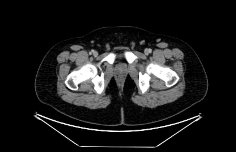 File:Adrenocortical carcinoma (Radiopaedia 80134-93438 Axial C+ portal venous phase 133).jpg