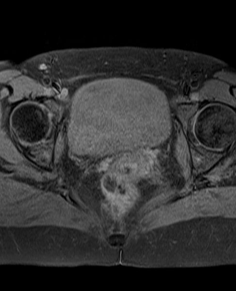 File:Adult granulosa cell tumor of the ovary (Radiopaedia 71581-81950 Axial T1 fat sat 20).jpg