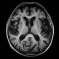 Alzheimer disease (Radiopaedia 10738-11199 Axial T1 11).jpg