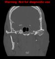Ameloblastoma (Radiopaedia 13276-13280 Coronal non-contrast 19).jpg