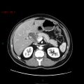 Ampullary carcinoma (Radiopaedia 56396-63056 B 27).jpg
