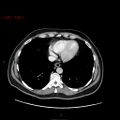 Ampullary carcinoma (Radiopaedia 56396-63056 C 9).jpg