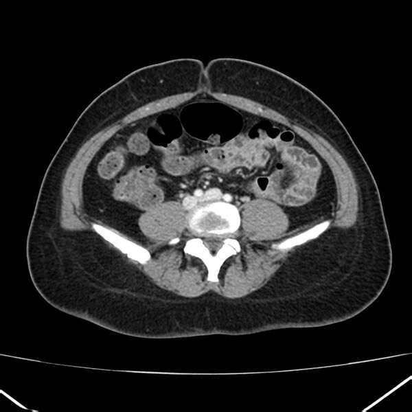 File:Ampullary tumor (Radiopaedia 22787-22816 C 43).jpg