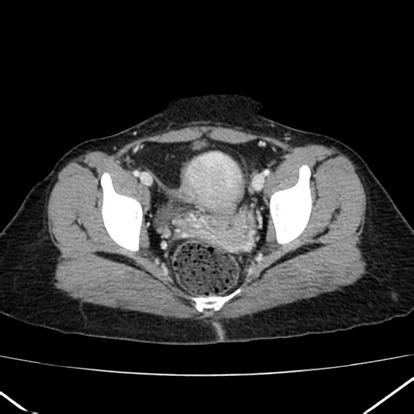 File:Ampullary tumor (Radiopaedia 22787-22816 C 62).jpg