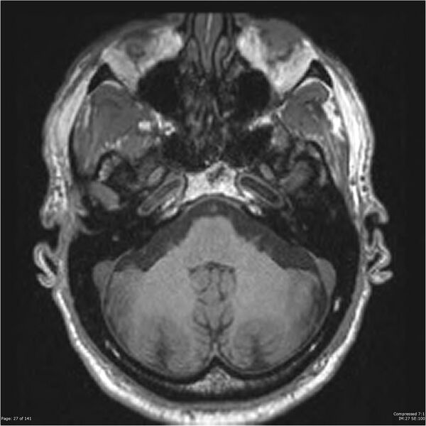 File:Anaplastic meningioma with recurrence (Radiopaedia 34452-35788 Axial T1 25).jpg