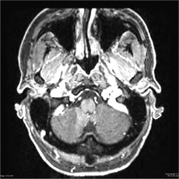 File:Anaplastic meningioma with recurrence (Radiopaedia 34452-35788 Axial T1 C+ 14).jpg