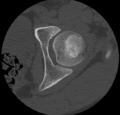 Aneurysmal bone cyst of ischium (Radiopaedia 25957-26094 B 7).png