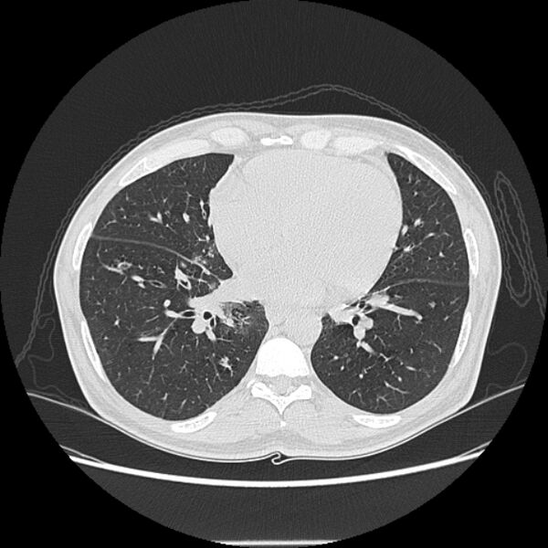 File:Angioinvasive aspergellosis (Radiopaedia 66995-76315 Axial lung window 32).jpg
