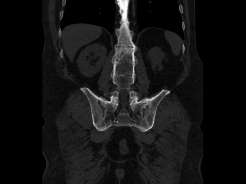 File:Ankylosing spondylitis (Radiopaedia 44609-48357 Coronal bone window 66).jpg