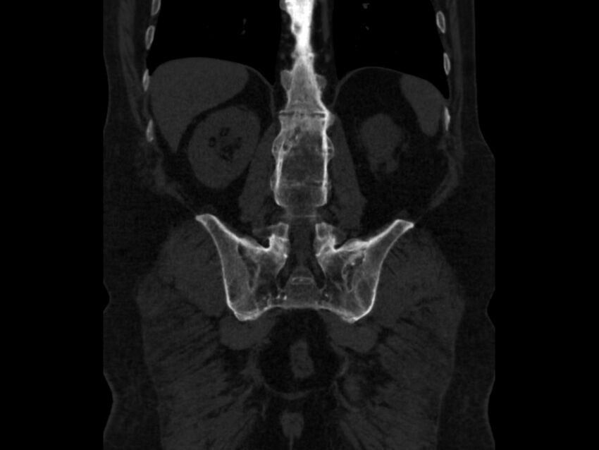 Ankylosing spondylitis (Radiopaedia 44609-48357 Coronal bone window 66).jpg
