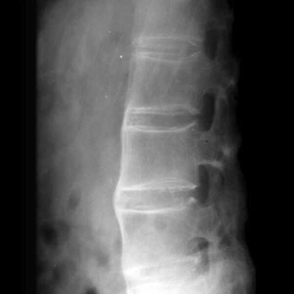 File:Ankylosing spondylitis - lumbar spine (Radiopaedia 7163-8136 Lateral 1).jpg