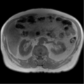 Annular pancreas (Radiopaedia 38292-40320 Axial T1 IN-OPP 43).png