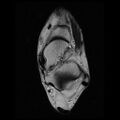 Anterior calcaneal process fracture (Radiopaedia 74654-85611 Axial T2 13).jpg