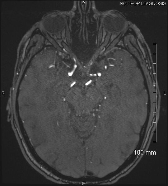 File:Anterior cerebral artery aneurysm (Radiopaedia 80683-94127 Axial MRA 96).jpg