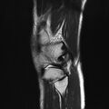 Anterior cruciate ligament full thickness tear (Radiopaedia 66268-75467 Sagittal T2 20).jpg