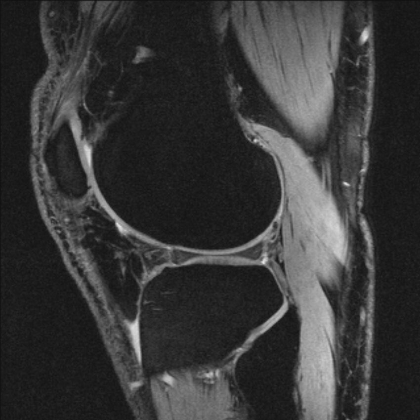 Anterior cruciate ligament mucoid degeneration (Radiopaedia 68400-77933 Sagittal 15).jpg