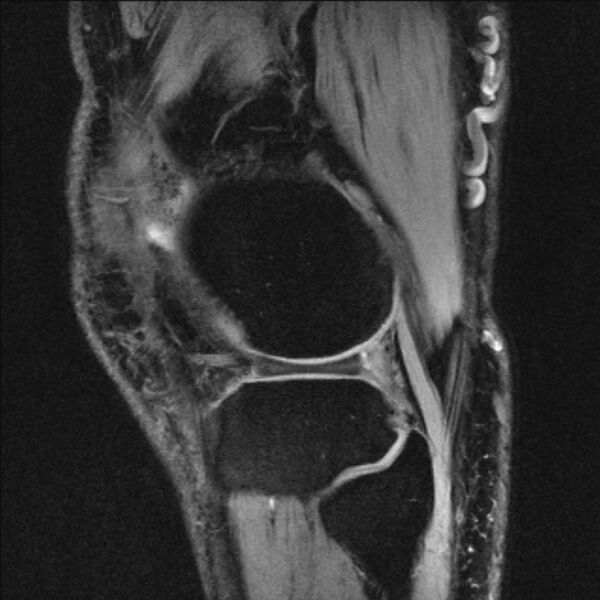 File:Anterior cruciate ligament mucoid degeneration (Radiopaedia 68400-77933 Sagittal 9).jpg