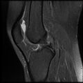 Anterior cruciate ligament tear, Wrisberg rip and bucket-handle tear of medial meniscus (Radiopaedia 75872-87266 Sagittal PD fat sat 12).jpg