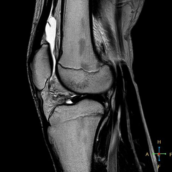 File:Anterior cruciate ligament tear - complete (Radiopaedia 24907-25170 Sagittal T2 7).jpg