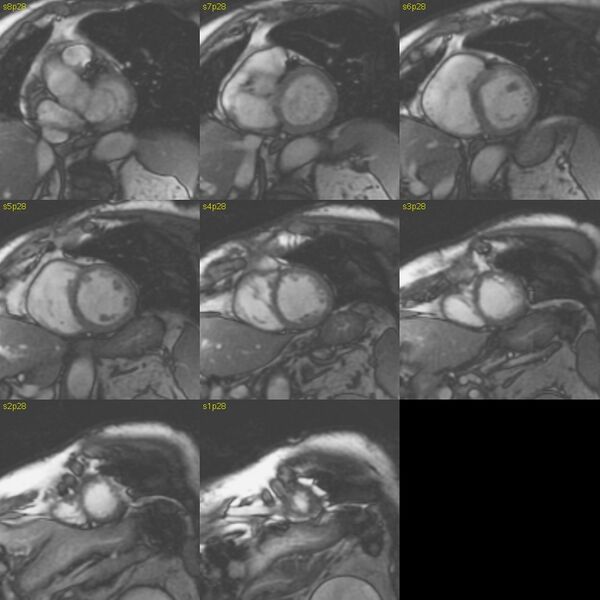 File:Anteroseptal hypokinesia after myocardial infarction (Radiopaedia 15978-15633 E 4).jpg
