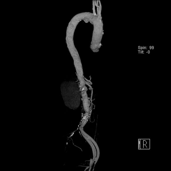 File:Aortic arch saccular aneurysm (Radiopaedia 19430-19457 A 14).jpg