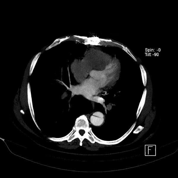 File:Aortic dissection - De Bakey type III - Stanford B (Radiopaedia 21903-21882 B 34).jpg