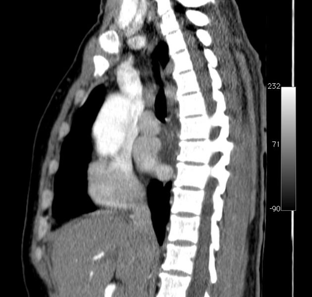 File:Aortic dissection - Stanford type A (Radiopaedia 29247-29659 C 33).jpg