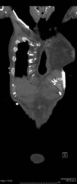 File:Aortic dissection with extension into aortic arch branches (Radiopaedia 64402-73204 A 7).jpg