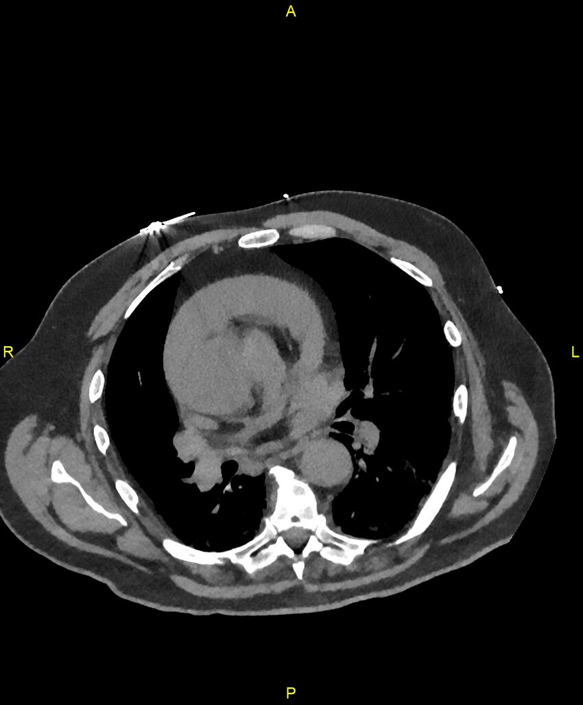 Aortic rupture (Radiopaedia 88822-105594 Axial non-contrast 107).jpg